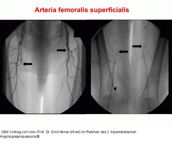 Arteria femoralis superficialis