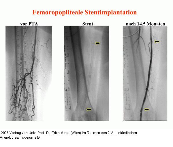 Femoropopliteale Stentimplantation