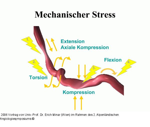 Stent - Mechanischer Stress