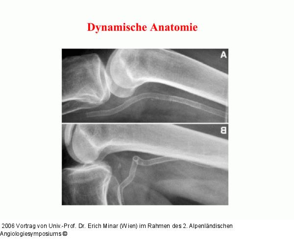 Stent - Dynamische Anatomie