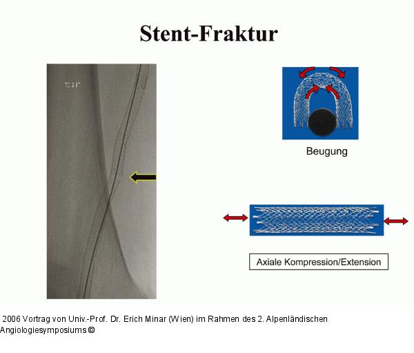 Stentfraktur