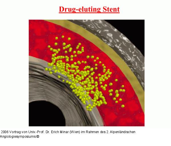 Drug-eluting Stent