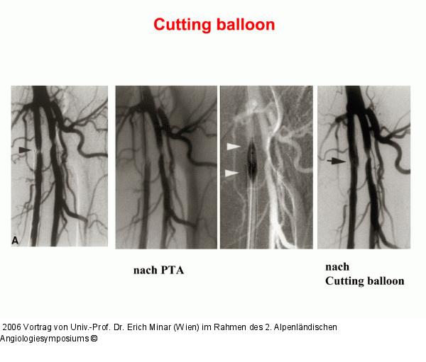 Cutting balloon