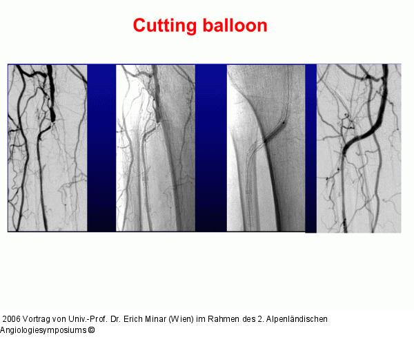 Cutting balloon