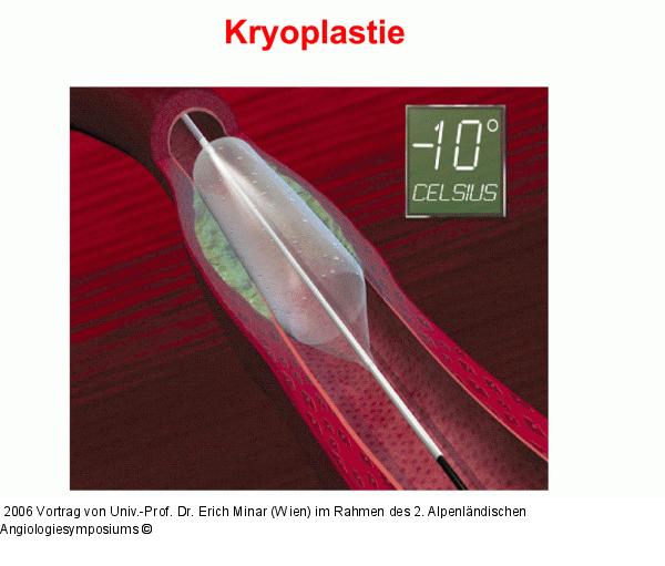 Kryoplastie