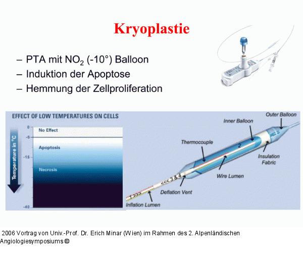Kryoplastie