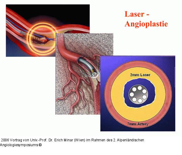 Laser-Angioplastie