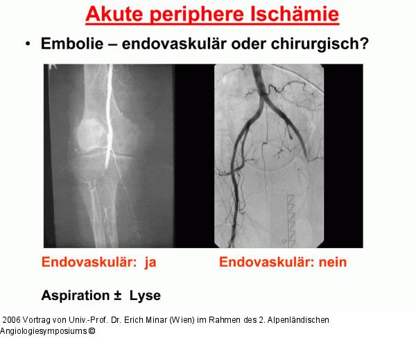 Akute periphäre Ischämie