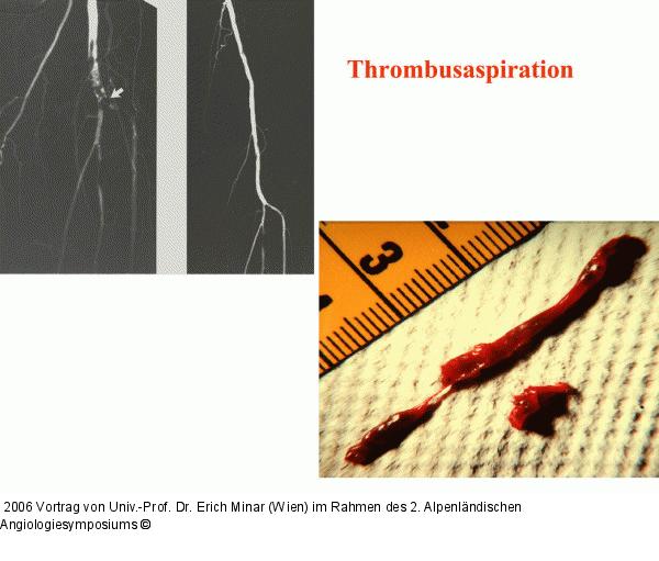 Thrombusaspiration