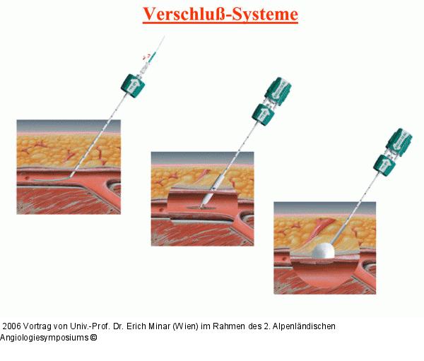 Verschlußsysteme
