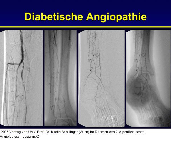 Diabetische Angiopathie