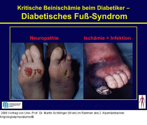 Diabetisches Fuß-Syndrom