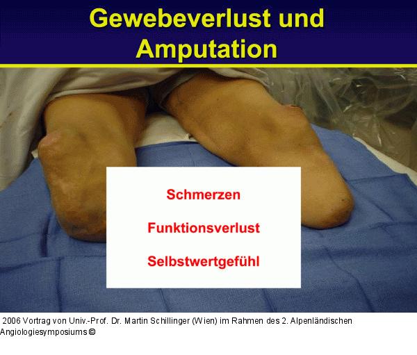 Gewebeverlust - Amputation