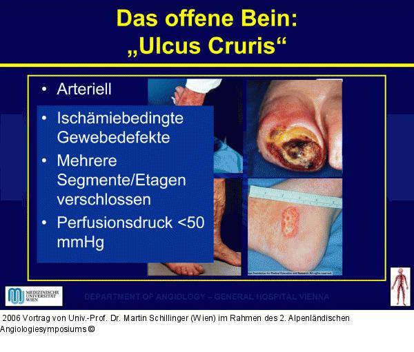 Ulcus cruris