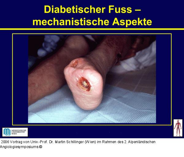 Diabetische Fuß