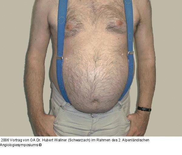 Adipositas - Fallbeispiel