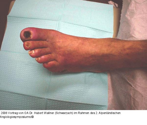 Kritische Beinischämie