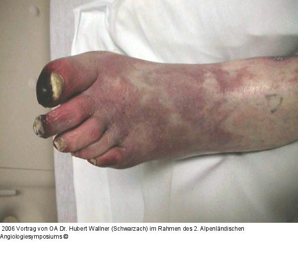 Kritische Beinischämie