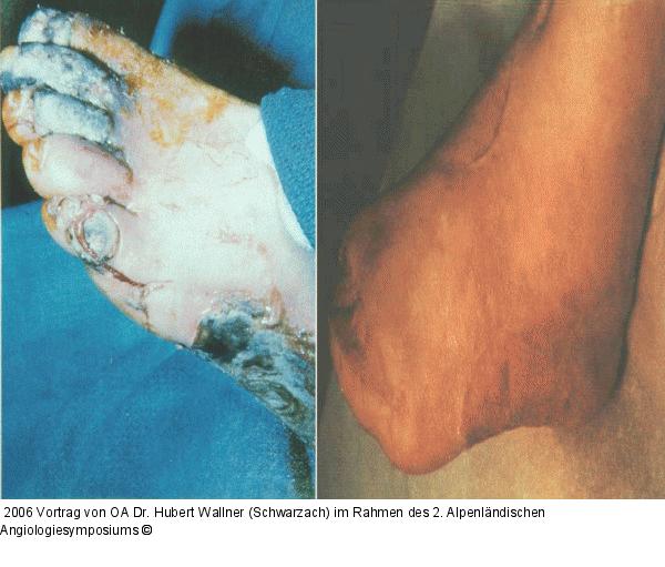 Kritische Beinischämie