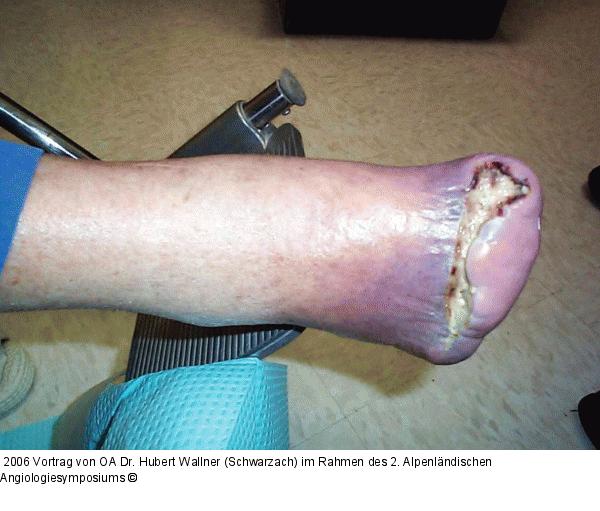 Kritische Beinischämie