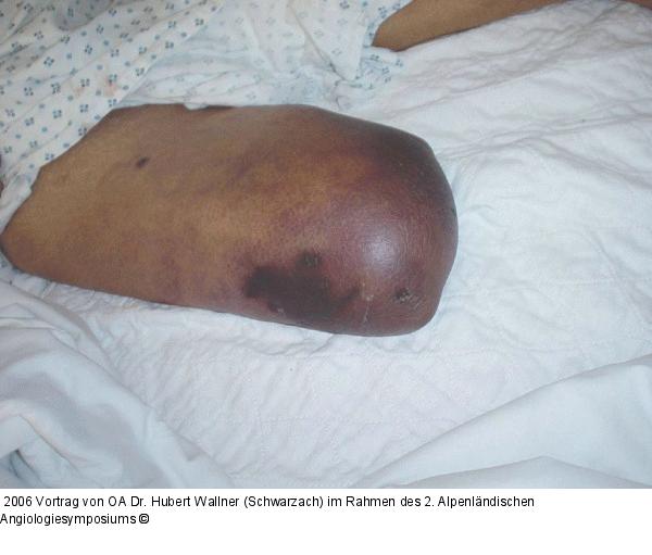 Kritische Beinischämie