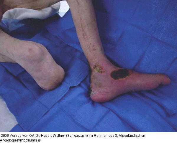 Kritische Beinischämie