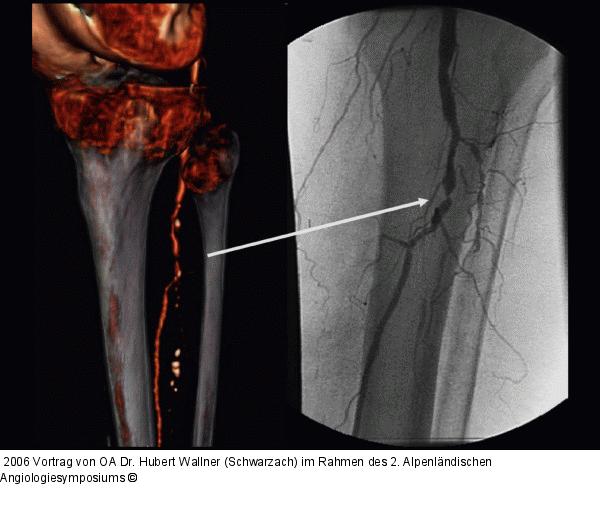 Kritische Beinischämie