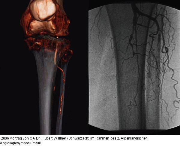Kritische Beinischämie