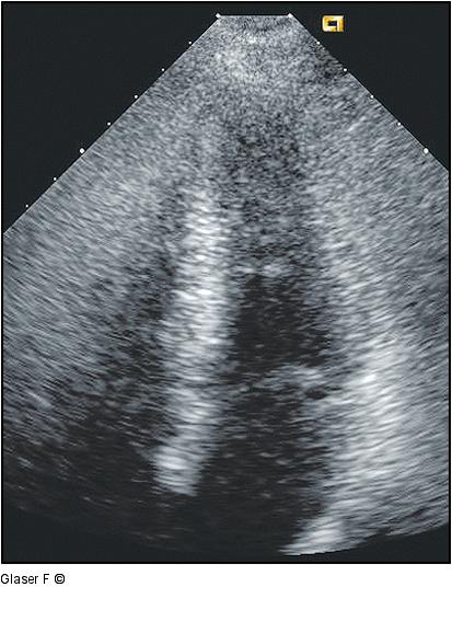 Hyperkinetische Herzaktion