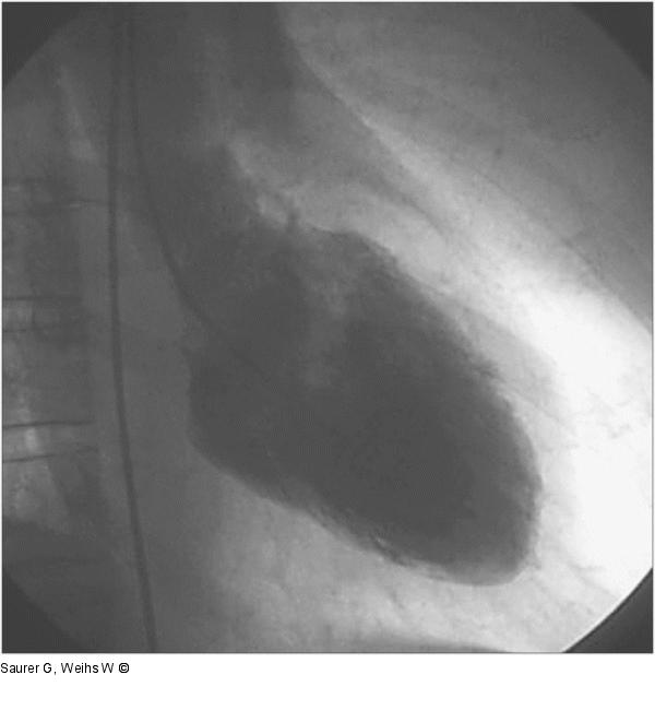 Laevokardiogramm - Diastole - Systole