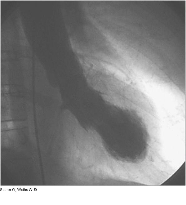 Laevokardiogramm - Diastole - Systole
