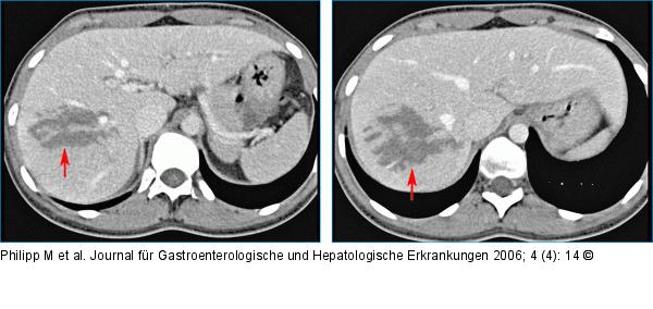 Leberlappen  - Ruptur