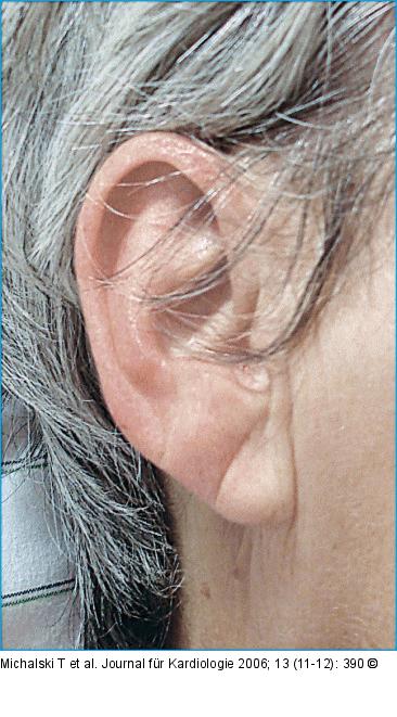 Diagonale Ohrläppchenfalte