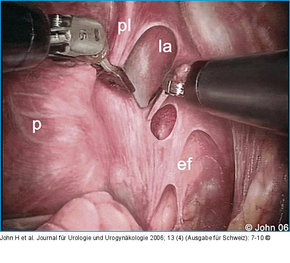 DaVinci-Prostatektomie - Technik