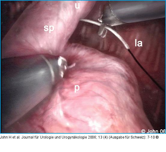 DaVinci-Prostatektomie - Technik