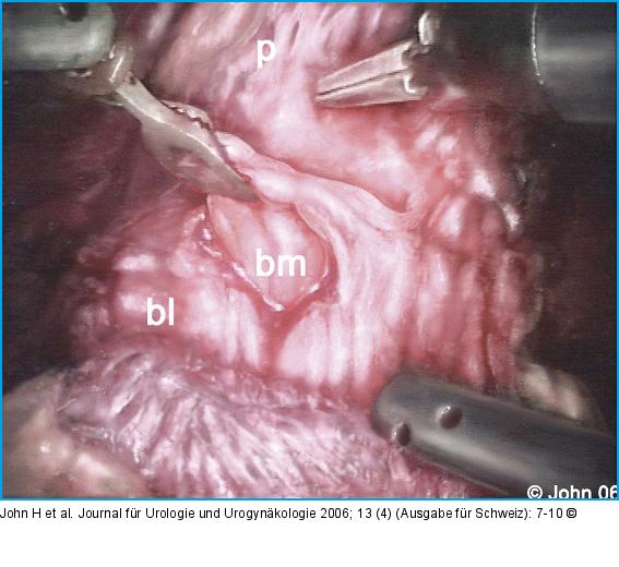 DaVinci-Prostatektomie - Technik