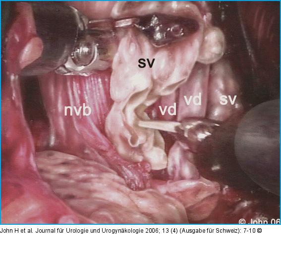 DaVinci-Prostatektomie - Technik