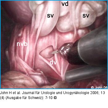 DaVinci-Prostatektomie - Technik