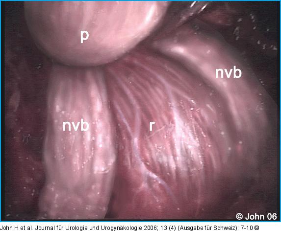 DaVinci-Prostatektomie - Technik