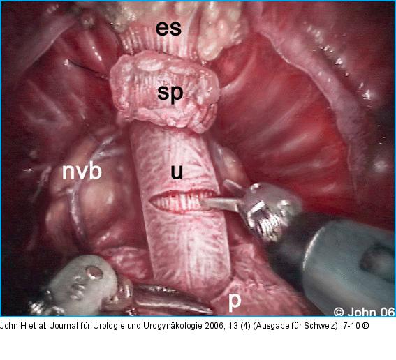 DaVinci-Prostatektomie - Technik