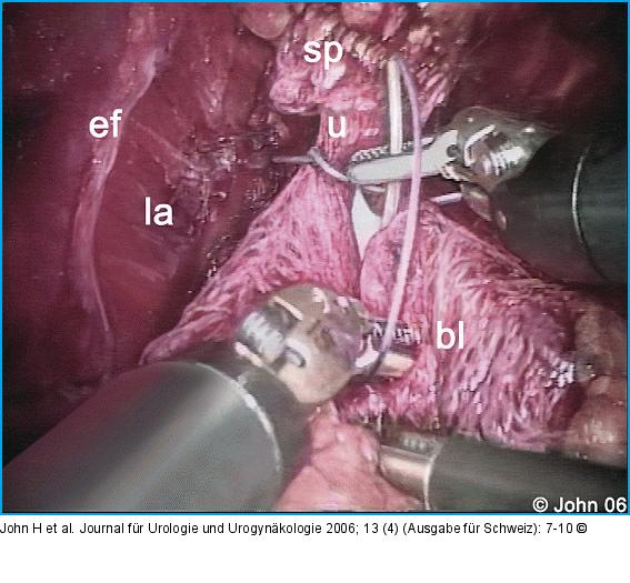 DaVinci-Prostatektomie - Technik