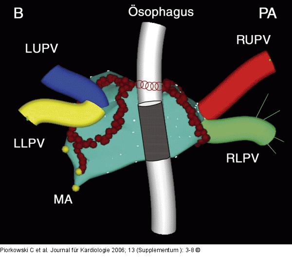Vorhof - Pulmonalvene