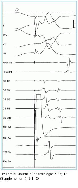 Intrakardiale Ableitung
