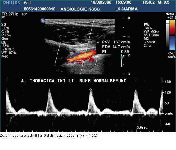 Arteria thoracica interna