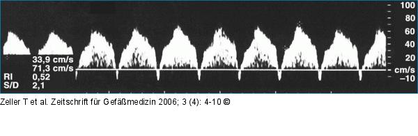 Arteria thoracica interna
