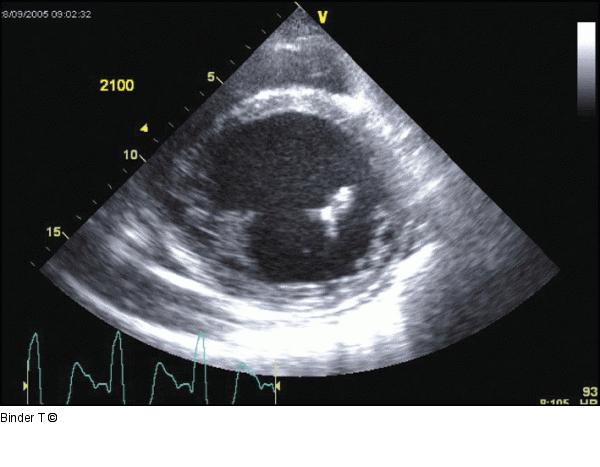 Parasternale kurze Achse