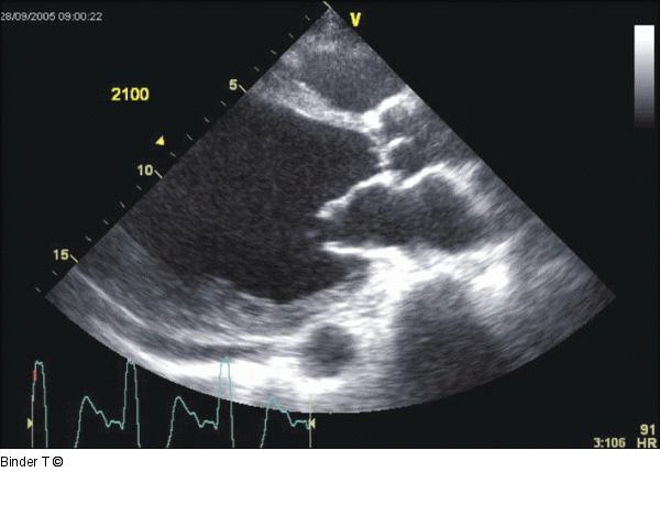 Parasternale lange Achse