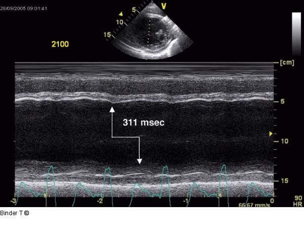 M-Mode linker Ventrikel - Septal-to-Posterior-Wall Motion Delay  (SPWMD)