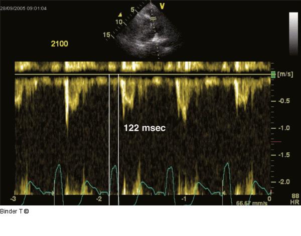 Pulmonales elektromechanischer Delay (P-EMD)