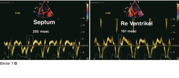 PW-Gewebedoppler (Septum/rechter Ventrikel)